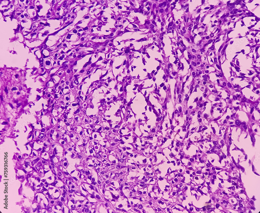 Nipple (biopsy) Invasive squamous cell carcinoma of nipple