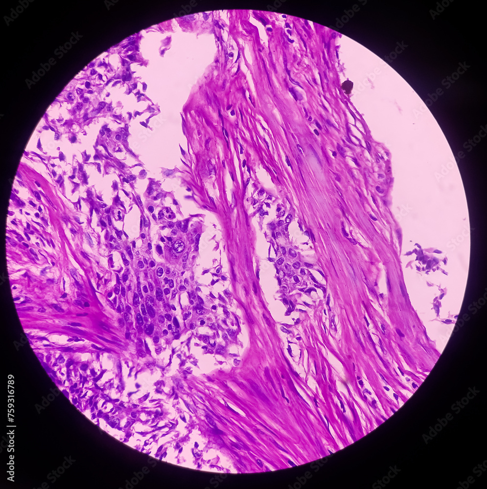 Nipple (biopsy) Invasive squamous cell carcinoma of nipple