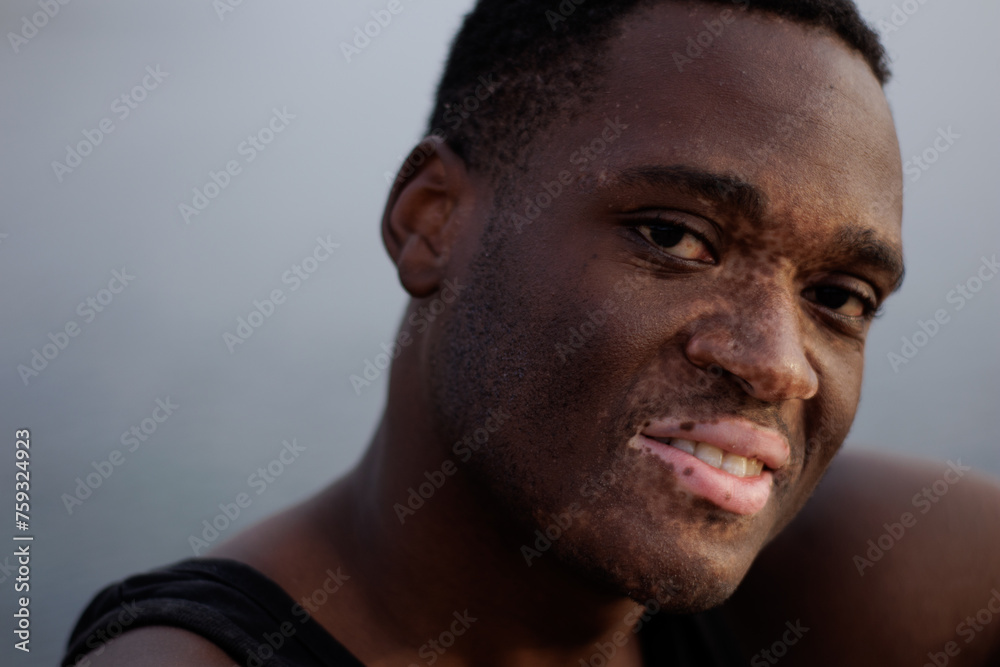 Young, black man with vitiligo Young, black man with vitiligo