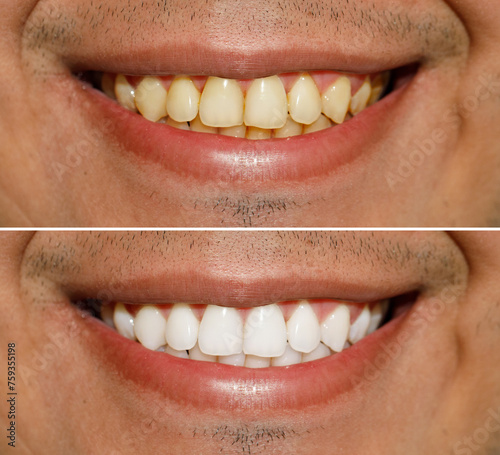 Teeth before and after whitening. Over white background. Dental clinic patient. Image symbolizes oral care dentistry, stomatology.