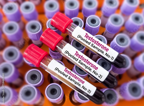 Quadro em tela Blood sample for Testosterone Test (Pooled 3 sample)