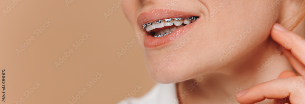 Obraz premium Close-up of a woman with braces on a beige background