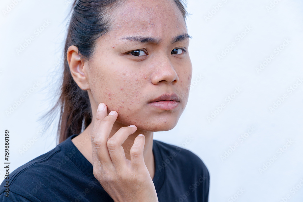 An Asian teenage girl with uneven facial skin problems. The invasion of acne, inflamed acne, clogged acne, pustules, chronic acne problems Redness on cheeks. Sensitive skin. Skin care concept. An Asian teenage girl with uneven facial skin problems. The invasion of acne, inflamed acne, clogged acne, pustules, chronic acne problems Redness on cheeks. Sensitive skin. Skin care concept.
