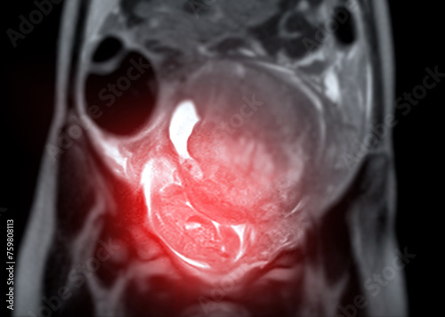 MRI during pregnancy ensures non-invasive evaluation of fetal health, maternal safety, obstetric care, and diagnostic precision, offering detailed imaging of fetal anatomy . photo