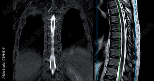 MRI T-L spine or Thoracosacral spine Axial and sagittal T2 technique with reference line  for diagnosis spinal cord compression. photo