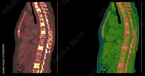 Photos bone metastasis , sagital  chest CT scan  images