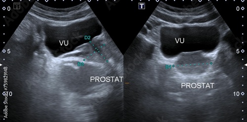  ultrasonography normal prostate
