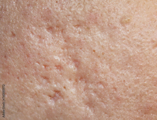 Problem skin with acne marks. Stock human skin texture in the best quality. Photo with scars.