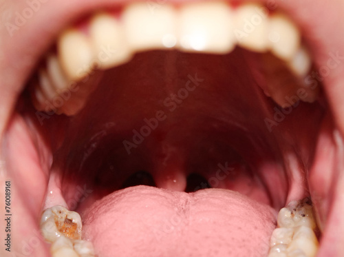 Open mouth with rotten wisdom teeth. Wisdom teeth removal concept. Stock photo of treatment at the dentist. photo
