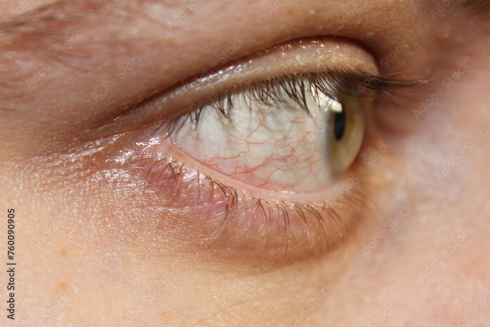 Obraz premium Tired green eye with red capillaries. The concept of long-term work at the computer and vision treatment. White of the eye with red veins. Stock photos of ophthalmology in the best quality.