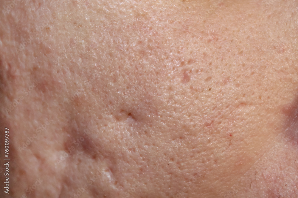 Problem skin with acne marks. Stock human skin texture in the best quality. Photo with scars.