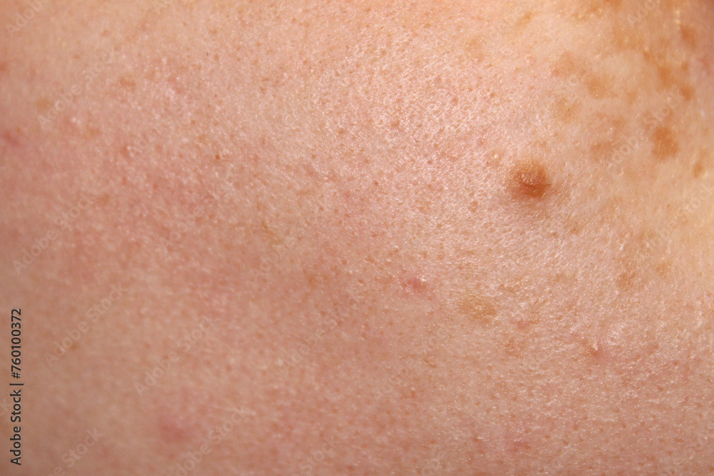 Skin texture of a girl with freckles and a birthmark close-up. Close-up stock photo of human skin in best quality.