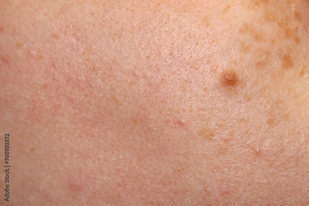 Skin texture of a girl with freckles and a birthmark close-up. Close-up stock photo of human skin in best quality. Skin texture of a girl with freckles and a birthmark close-up. Close-up stock photo of human skin in best quality.