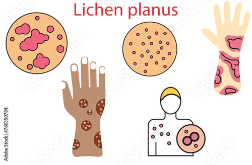 Lichen planus,non-infectious, itchy rash that can affect many areas of the body,skin illustration,arms, legs and trunk,fungus,Skin Problem,five vectors