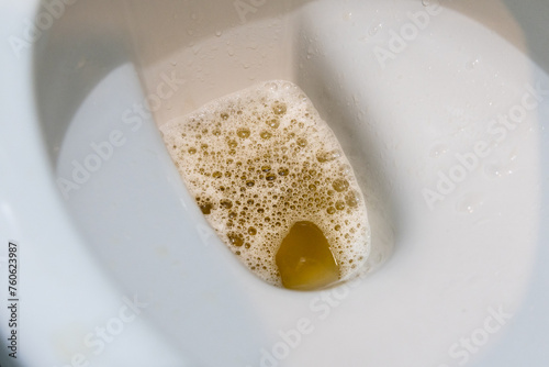 Closeup on yellowish urine with bubble in toilet bowl may indicate health problem