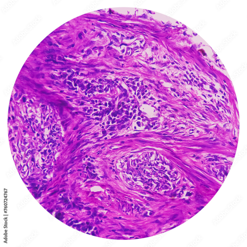 Nipple (biopsy) Invasive squamous cell carcinoma of nipple