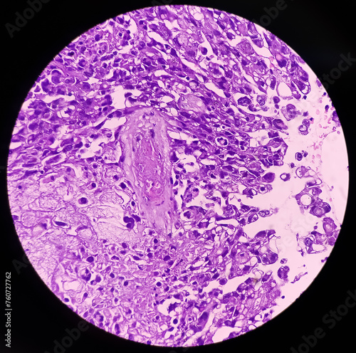 Kidney cancer: Microscopic image of metastatic clear cell carcinoma of kidney, the most common type of renal cell carcinoma. Show brain tissue of malignant neoplasm, large atypical bizarre cells. photo