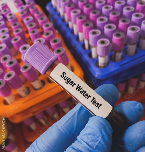 Blood sample for Sugar Water Test, to diagnose paroxysmal nocturnal hemoglobinuria (PNH). HAM'S Test. photo