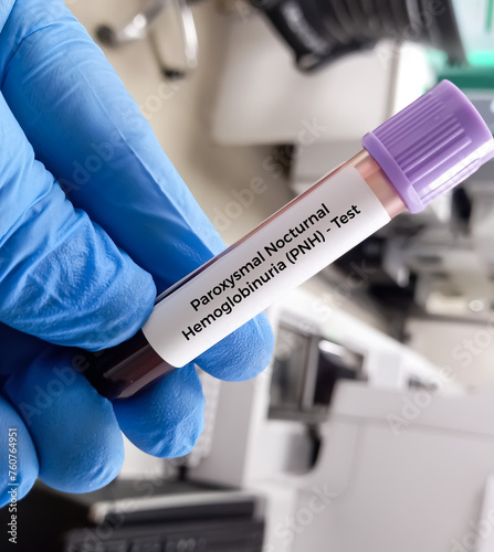 Blood sample for Paroxysmal nocturnal hemoglobinuria (PNH) disease test. HAM'S Test. photo