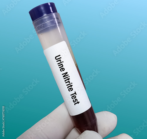 Medical Technologist holding urine analysis test sample for urine nitrate test, It's sign of a urinary tract infection (UTI).