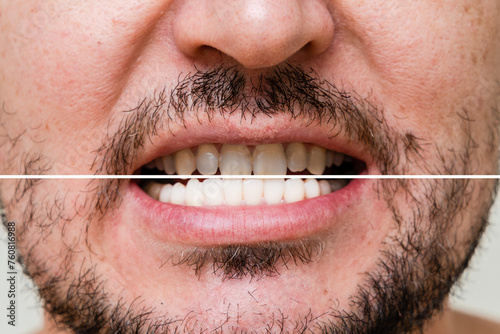 Man s teeth before and after whitening and alignment  braces . Oral care
