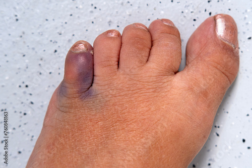 close-up part of female foot, subcutaneous hemorrhage on little toe, concept of fracture, bruise, redness in area of injury, soft tissue edema, industrial or domestic injury photo