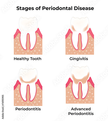 Stages of Periodontal Disease Science Design Vector Illustration Diagram