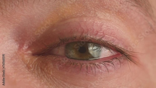 Close up annoyed red blood eye of man affected by conjunctivitis or after flu, cold or allergy. Male with vision problems, nearsightedness, eyelids inflammation and conjunctivitis eye pupil and iris photo