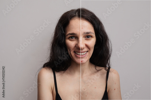 A shot of the face and body of a young woman with skin problems - pimples, acne, enlarged pores. with and without filter photo