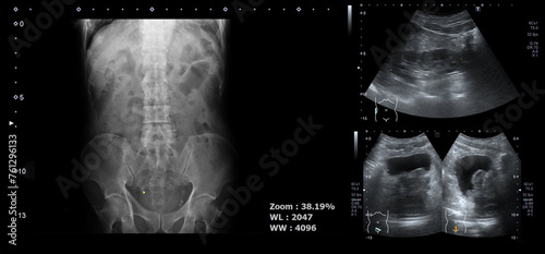 x-ray images of spine or spinal and urinary bladders or bladder for check prostate, gland or prostatic. photo