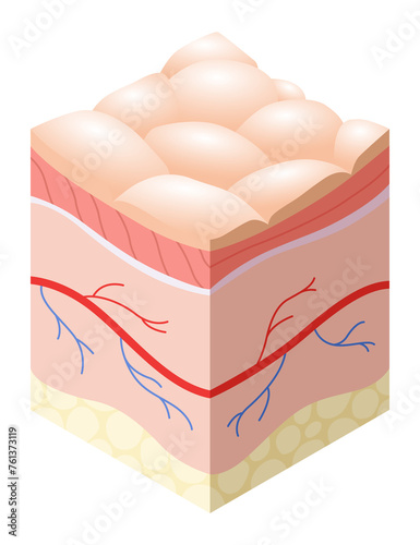 Skincare medical concept. Problems in cross-section of human skin horizontal layers structure. Anatomy illustrative model unhealthy layer of skin