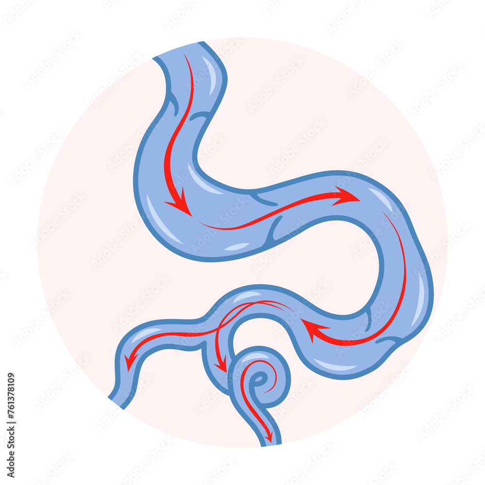 Varicose veins. Blue blood vessel visible through the skin. Vascular disease diagnostic and treatment. Venous insufficiency medical Varicose veins. Blue blood vessel visible through the skin. Vascular disease diagnostic and treatment. Venous insufficiency medical