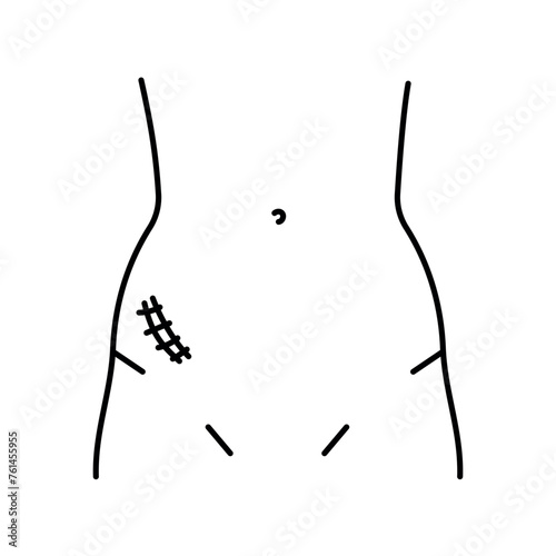 Mcburney incision line icon. Abdominal incisions.