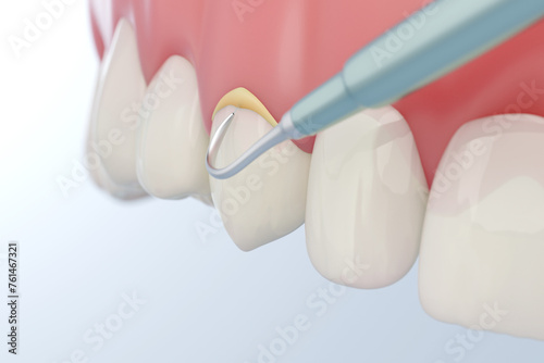 Obraz na plátně Dental tartar or calculus removal, 3D rendering.