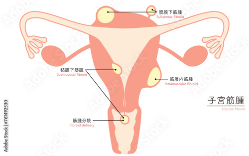 子宮筋腫の図解イラスト、子宮・卵巣の解剖図 photo