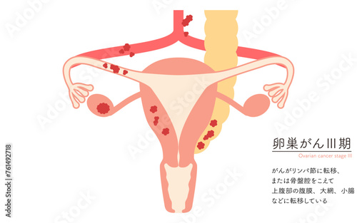 卵巣がんIII期の図解イラスト、子宮・卵巣の解剖図
