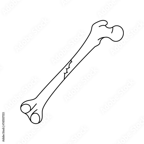 Oblique nondisplaced bone fracture  line icon.