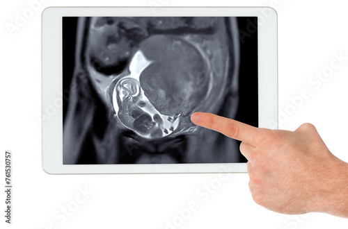 MRI during pregnancy ensures non-invasive evaluation of fetal health on tablet, maternal safety, obstetric care, and diagnostic precision, offering detailed imaging of fetal anatomy .Clipping path.