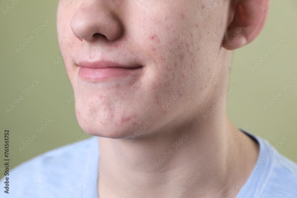 Obraz premium Young man with acne problem on olive background, closeup