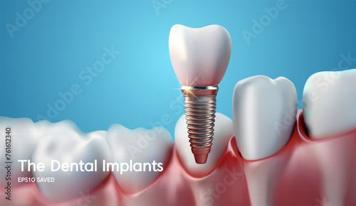 White tooth implant implant cut, healthy tooth or dental surgery. vector illstration.