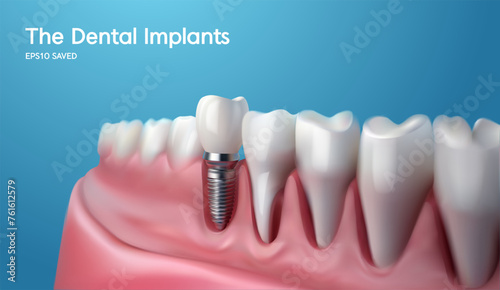 White tooth implant implant cut, healthy tooth or dental surgery. vector illstration.