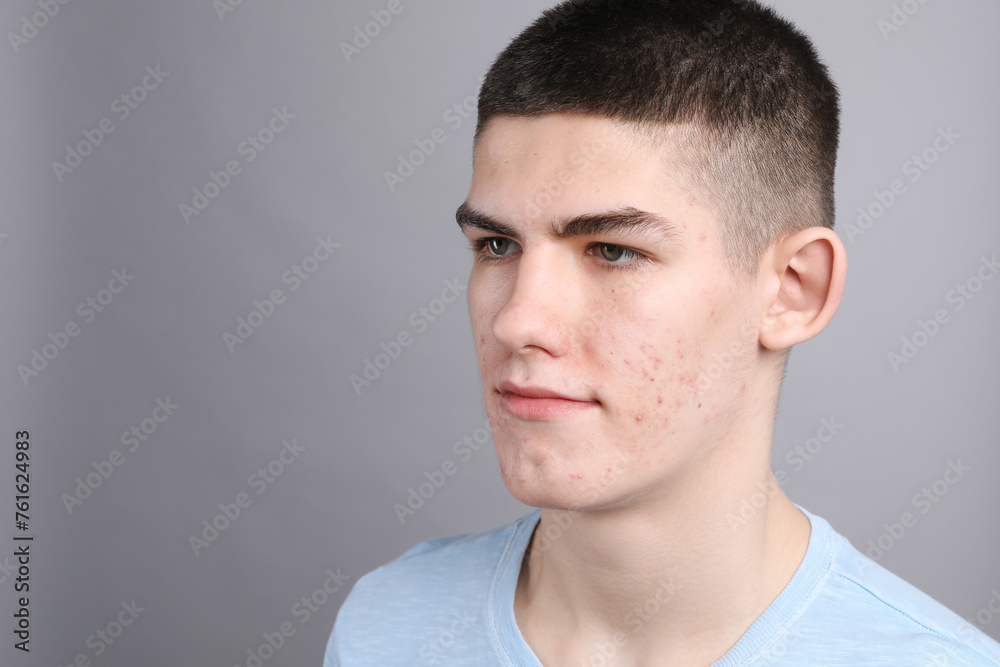 Fototapeta premium Young man with acne problem on grey background. Space for text