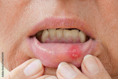 stomatitis in mouth closeup, close-up on the lip with aphthous stomatitis, treatment of inflammation of the oral mucosa