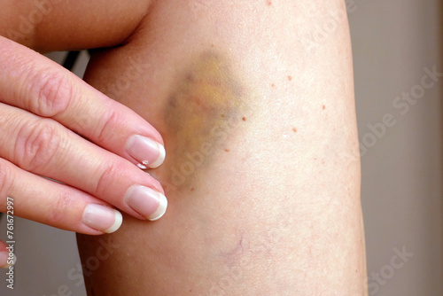 Closeup of bruise occur on middle aged woman leg. Varicose veins illness  and bruise treatment with medical ointment