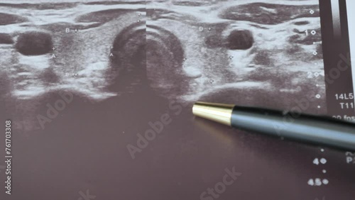 An endocrinologist analyzes an ultrasound of the thyroid gland photo