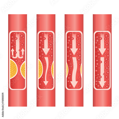 Human atherosclerosis stock illustration