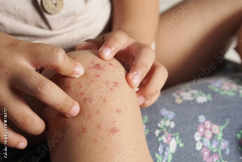 Close up view of Boy showing his knee infected with hand feet and mouth disease or HFMD originating from enterovirus or coxsackie virus, photo