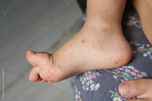 Close up view of child's feet infected with hand feet and mouth disease or HFMD originating from enterovirus or coxsackie virus, close up view zoom shot.