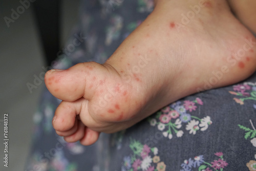 Close up view of child's feet infected with hand feet and mouth disease or HFMD originating from enterovirus or coxsackie virus, close up view zoom shot.