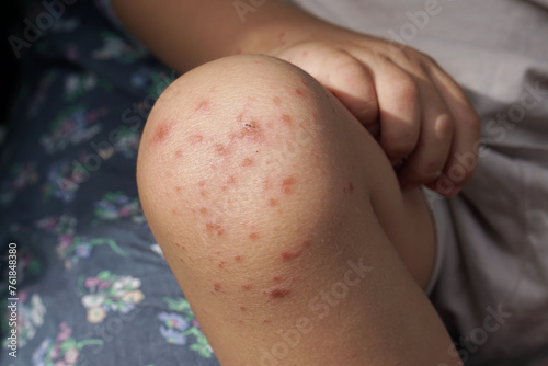 knee of a child infected with hand feet and mouth disease or HFMD originating from enterovirus or coxsackie virus, close up view zoom shot. photo